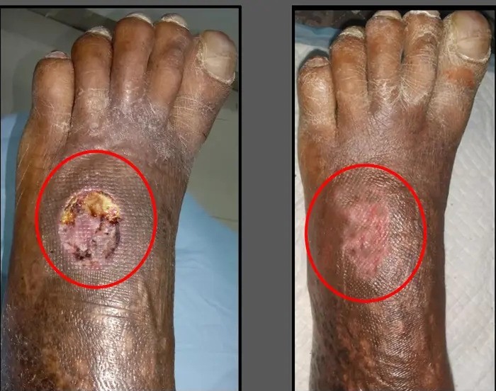 Diabetic Cellulitis and Coverage