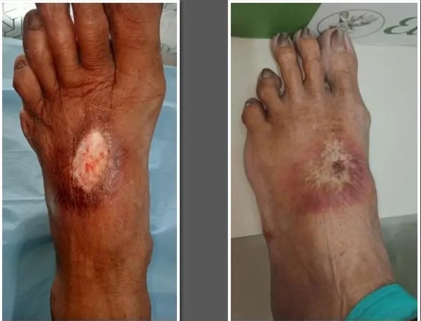 Diabetic Cellulitis and fdytukl